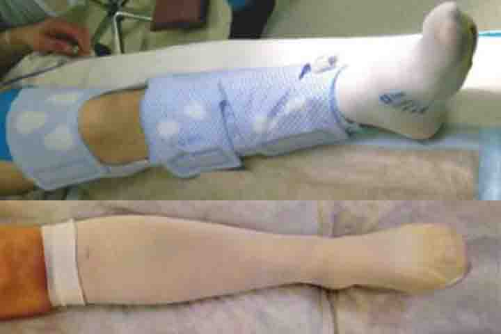 Essa condição é mais frequente em caso de cirurgias recentes, períodos longos de imobilidade, uso de anticoncepcionais com estrogênio ou terapia de reposição hormonal.