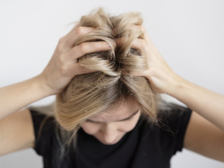 Entre os sintomas mais comuns estão coceira persistente, descamação, vermelhidão, ardência e queda acima do normal