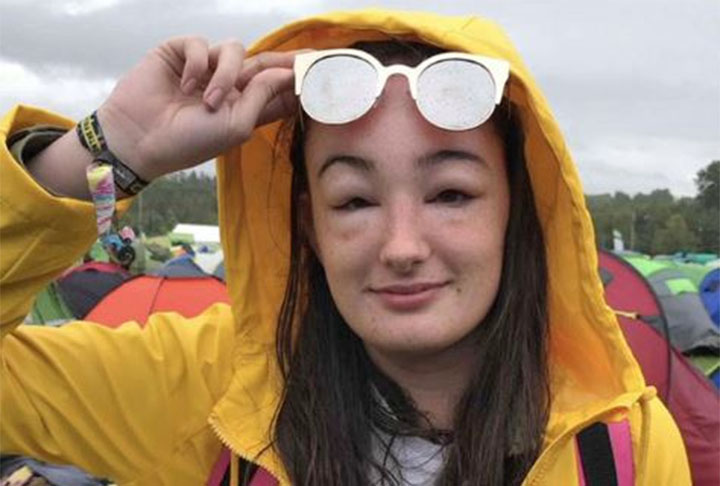 Essa reação alérgica que Felipe sofreu é conhecida como ‘angiodema’ e se caracteriza exatamente pelo inchaço de regiões como os olhos e os lábios .