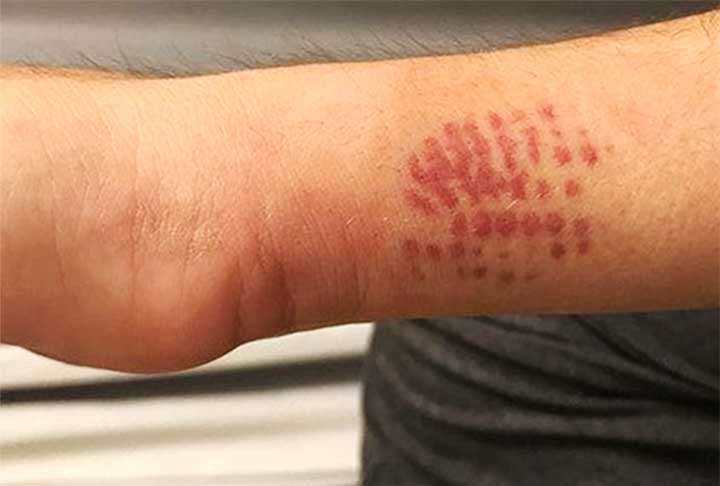 Os envenenamentos por lagartas são os menos comuns e que menos causam óbitos no Brasil. Foram quatro em 2023. Todavia, são perigosos por serem desconhecidos da população. Casos com escorpiões e serpentes são mais comuns. 