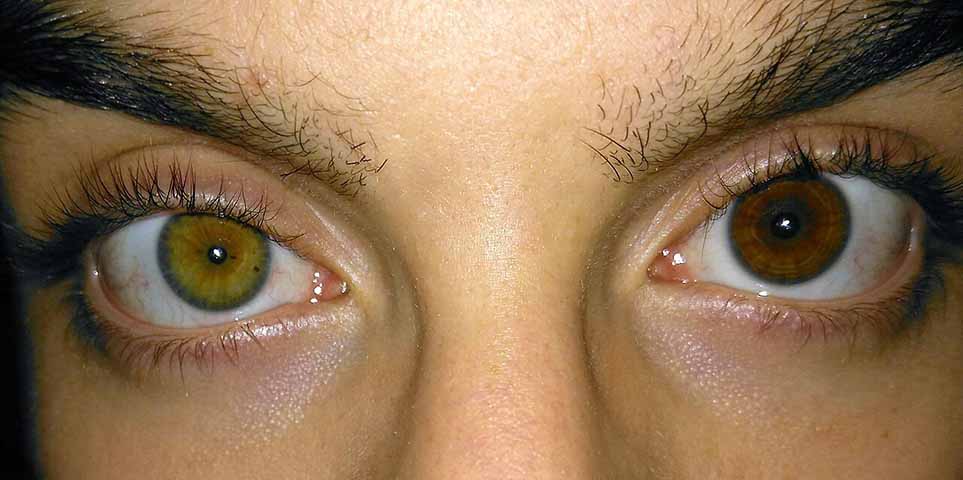 A heterocromia pode ser congÃªnita - presente desde o nascimento - ou adquirida, causada por traumas, doenÃ§as ou uso de certos medicamentos. Em muitos casos, especialmente quando congÃªnita, Ã© apenas uma caracterÃ­stica estÃ©tica e nÃ£o afeta a visÃ£o. Algumas pessoas famosas tÃªm heterocromia e talvez vocÃª nÃ£o saiba. Confira a seguir!
