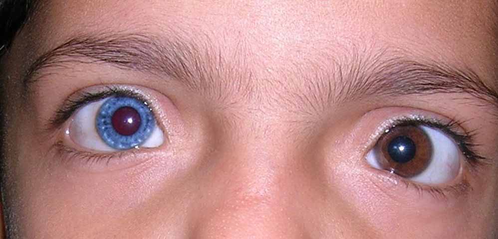 A heterocromia pode ocorrer de duas formas principais: a heterocromia completa, quando cada olho tem uma cor diferente - por exemplo, um azul e outro castanho - e a heterocromia parcial, quando um mesmo olho tem duas cores distintas, como uma mancha de outra cor dentro da íris.


