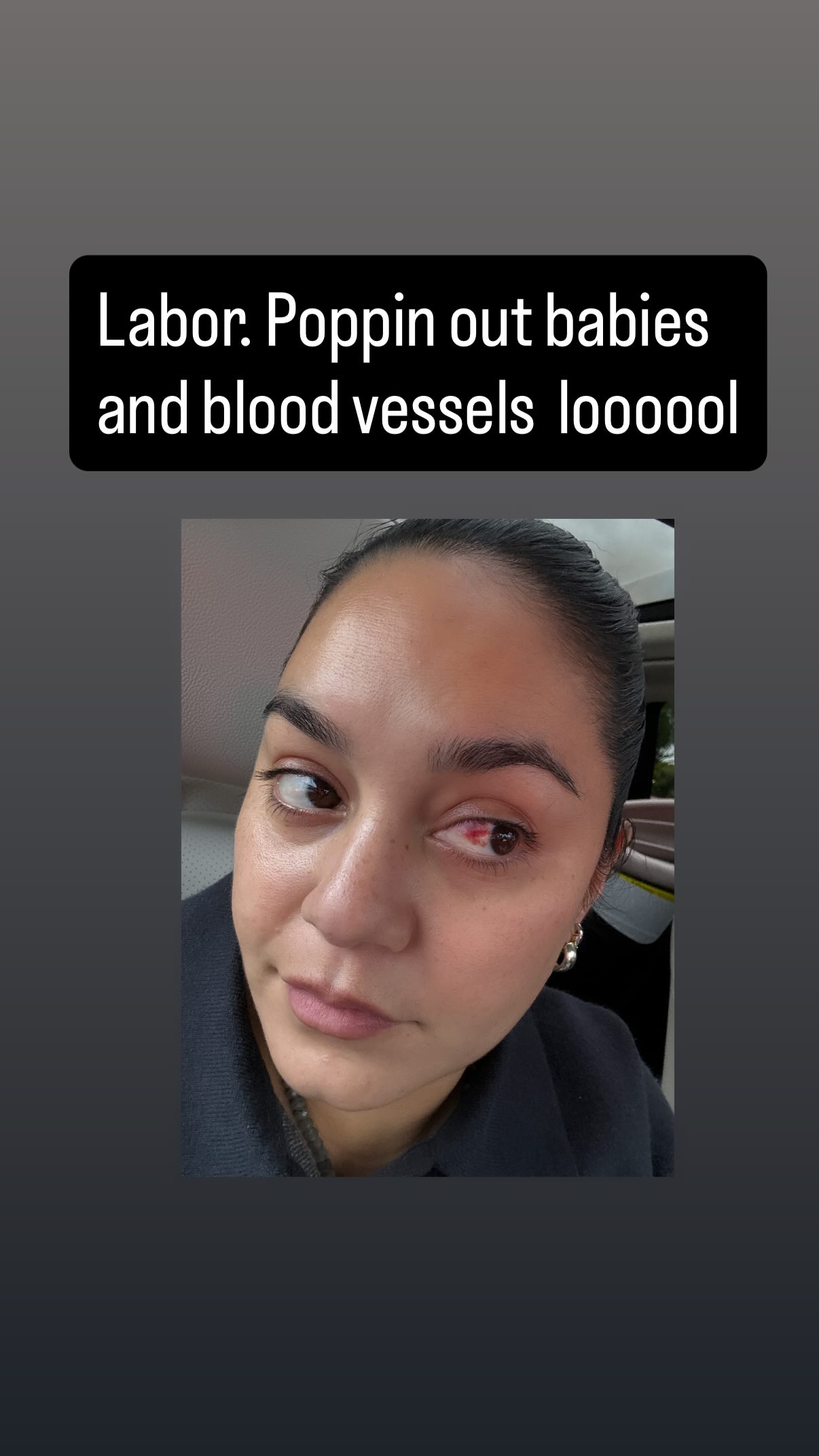 Vanessa também contou que teve uma veia do olho rompida, algo comum em situações de esforço extremo. A psiquiatra Dra. Luana Carvalho explicou à Caras Brasil que relatos assim ajudam a desconstruir a ideia de uma maternidade perfeita e acolhem mulheres que enfrentam o pós-parto com cansaço físico e emocional. 
