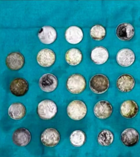 Esses objetos bloquearam o intestino, exigindo uma cirurgia de emergência para removê-los. Por sorte, os médicos conseguiram abrir o órgão e retirar todas as moedas e ímãs. 