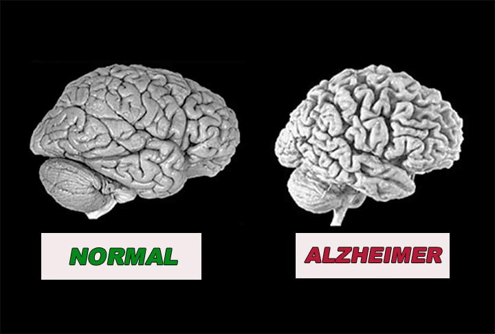 Os exames no jovem identificaram uma atrofia do hipocampo cerebral, além do acúmulo da proteína beta. As duas são características da doença. Também houve um aumento da proteína tau, outra característica. 