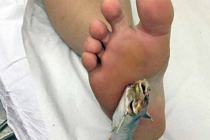 O contato com a pele humana pode provocar ferimentos dolorosos e inflamações, e já há relatos de pessoas machucadas em decorrência desse tipo de acidente na região. 