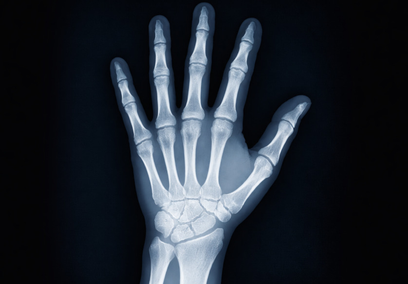 Estudos observacionais acompanharam pessoas que estalam os dedos por anos. Não foi encontrada maior incidência de artrite nesses grupos.