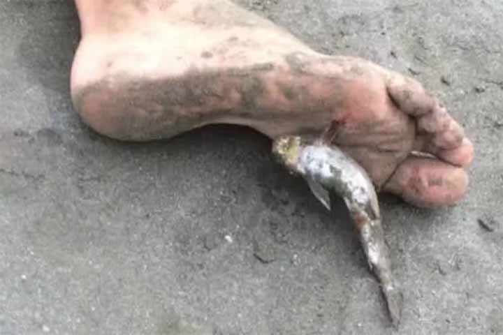 Em situações de ferimento causado pelo ferrão do bagre, a recomendação é buscar atendimento médico o mais rápido possível. 
