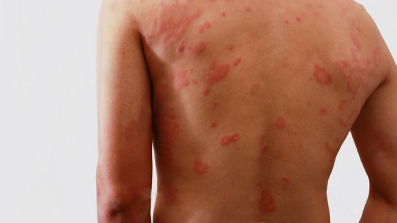 Hanseníase tem cura e tratamento gratuito ofertado pelo SUS; saiba mais 