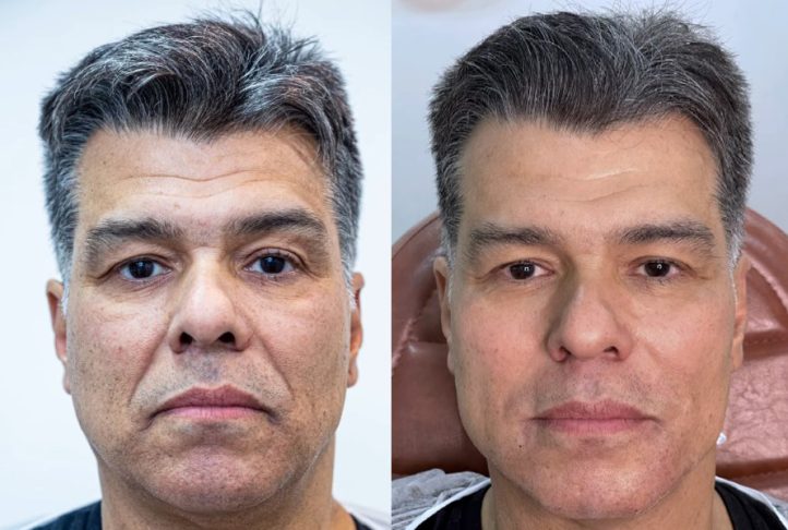Maurício Mattar – Comemorou os resultados da harmonização facial em julho de 2022, assim como o ex-BBB Lucas Bissoli, que fez na mesma clínica.
