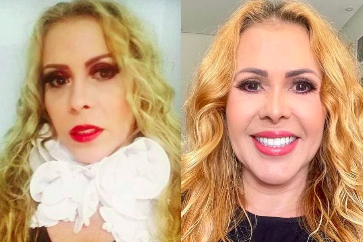 Joelma – A cantora paraense já realizou inúmeros procedimentos no rosto. Em 2019, ela confessou que amou o resultado.