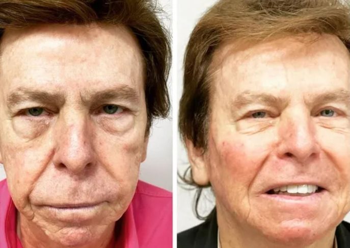 Nelson Rubens – O apresentador da RedeTV! passou por um procedimento com 19 seringas de preenchimento para reposição volumétrica facial.