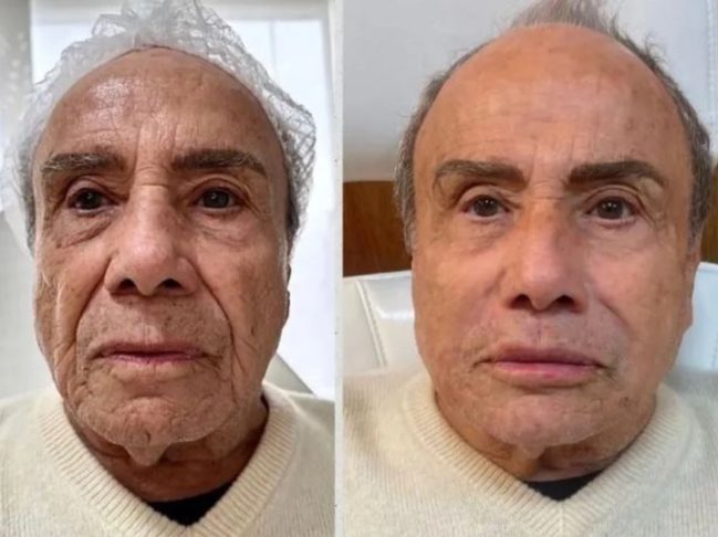 Stenio Garcia – O ator harmonizou o rosto em junho de 2023, mas negou relação entre o tratamento e uma internação no mês seguinte.