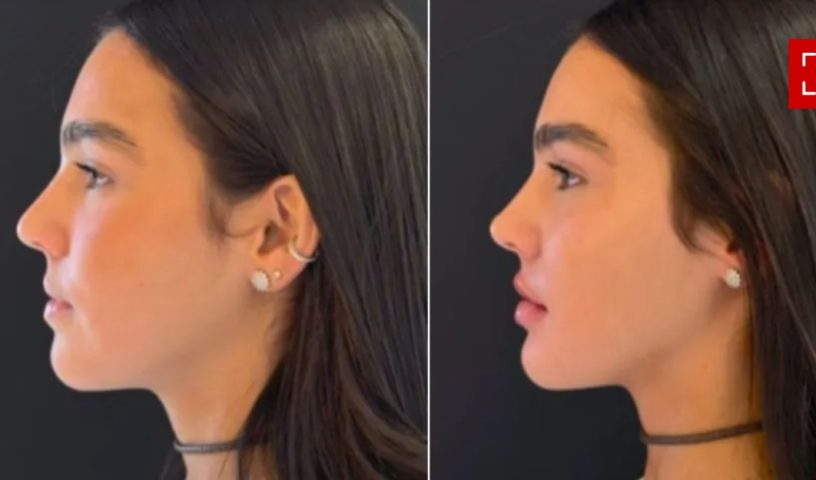 Duda Guerra – A namorada de Benício Huck (filho de Luciano Huck e Angélica) fez ajustes no rosto em outubro de 2024. Ela disse que se sentia incomodada com a pontinha do nariz.