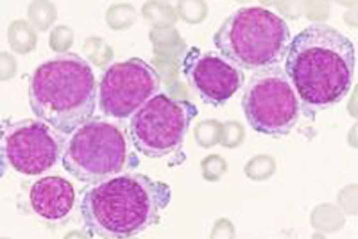 <p>Nessa condição maligna, ocorre uma produção descontrolada de células imaturas da linhagem mieloide – precursoras de glóbulos vermelhos, glóbulos brancos e plaquetas – que não completam seu desenvolvimento.</p>
