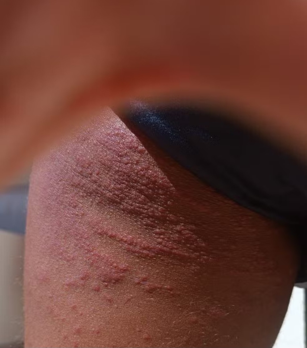 <p>Mas se a pessoa tiver alergia, ela pode ficar com urticária e anafilaxia, que devem ser tratadas com antialérgicos ou corticosteróides prescritos por médicos de forma controlada.</p>
