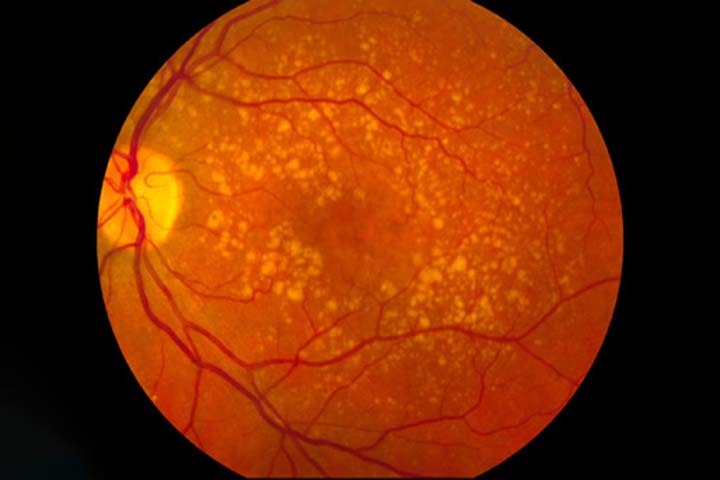 <p>A degeneração macular é uma condição ocular caracterizada pelo desgaste gradual da mácula, a região central da retina responsável pela nitidez da visão.</p><?php if (strpos(site('ds_site_link'), '/apostas') === false): ?>

    </div>

    <div class=