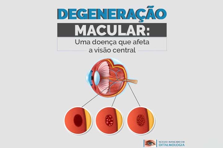 <p>Existem dois tipos principais da doença: a degeneração macular seca e a úmida. A forma seca, mais comum, ocorre de maneira lenta e progressiva, decorrente do afinamento natural da mácula e do acúmulo de depósitos chamados drusas.</p>
