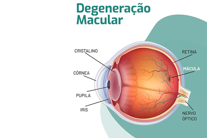 <p>Já a forma úmida, menos frequente, é mais agressiva e resulta do crescimento anormal de vasos sanguíneos sob a retina, que podem vazar líquido ou sangue e causar perda visual mais rápida.</p>
