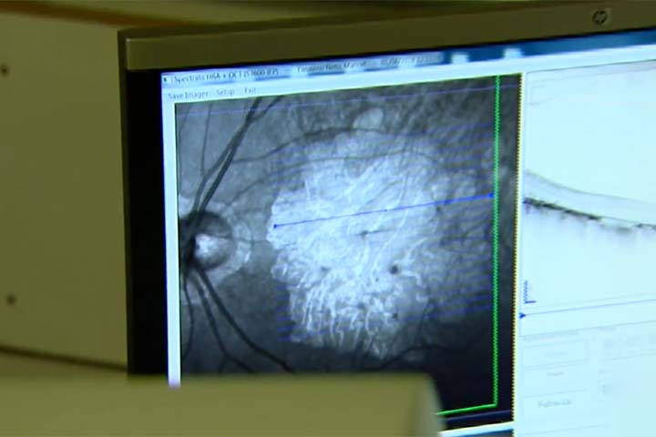 <p>Embora ainda não exista cura, há formas de retardar sua progressão e, em alguns casos – especialmente na DMRI úmida – preservar parte da visão com tratamentos como injeções intraoculares, laser ou terapias medicamentosas específicas.</p>
