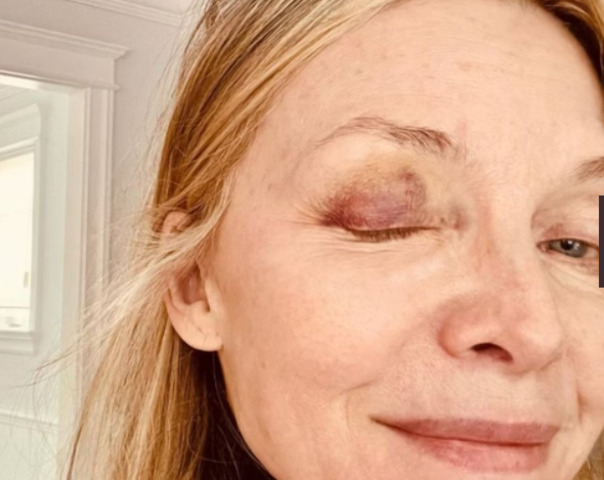 <p>No fim de 2023, ela surgiu com um olho roxo, causando apreensão nos fãs. E explicou nas redes sociais que tinha sofrido um acidente doméstico com bola de pickleball.</p>
