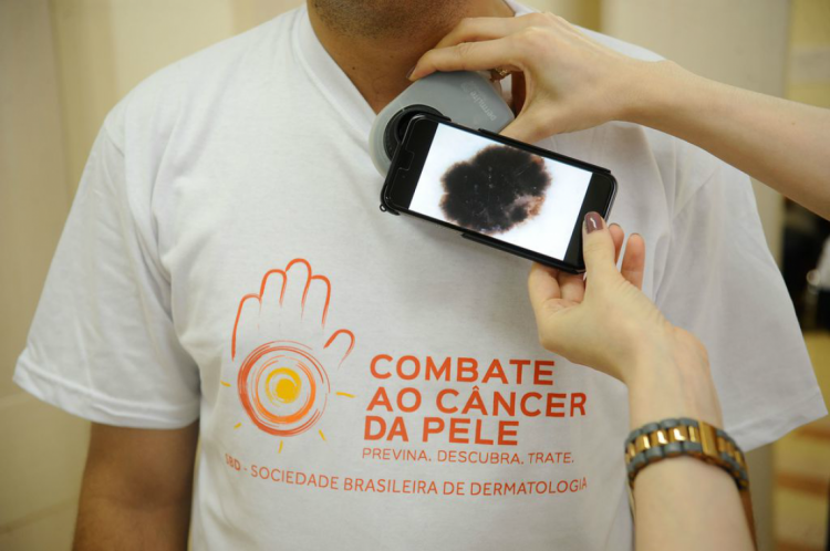 Mutirão para prevenção de câncer de pele será realizado neste domingo, em Fortaleza e Juazeiro