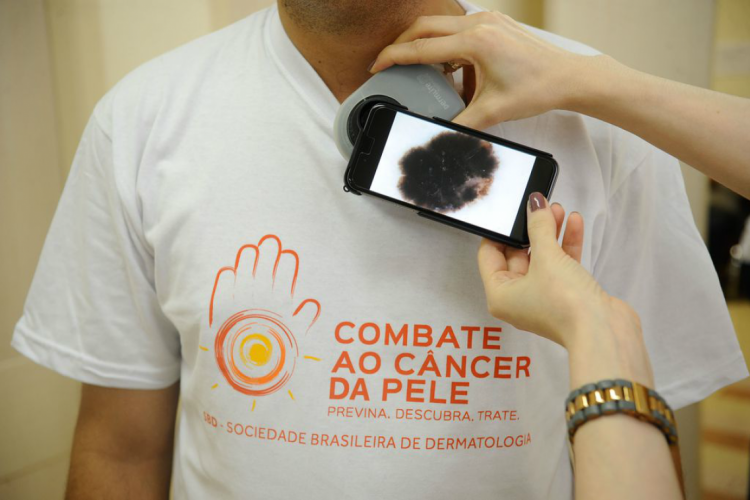 Mutirão para prevenção de câncer de pele será realizado neste domingo, em Fortaleza e Juazei...