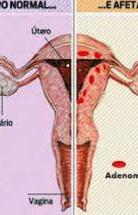 A adenomiose pode ser mais recorrente ap&oacute;s cirurgias realizadas previamente no &uacute;tero, como ces&aacute;reas.