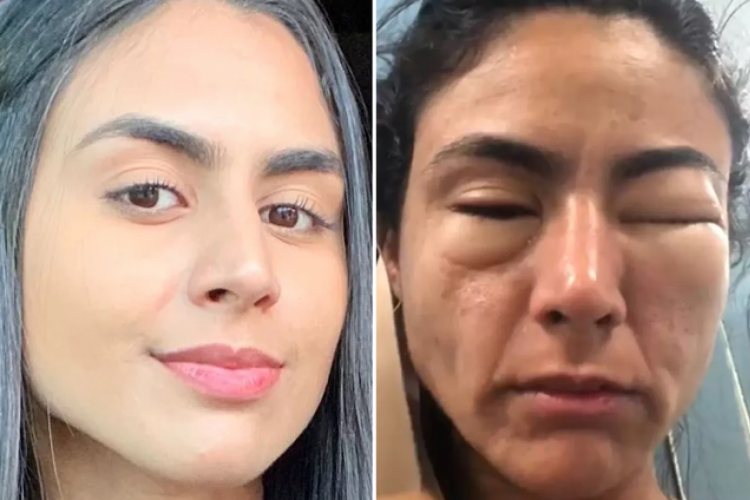 Segundo a mineira , todos na rua achavam que ela havia apanhado e, para amenizar a situação, passou os sete dias restantes da viagem de óculos de sol