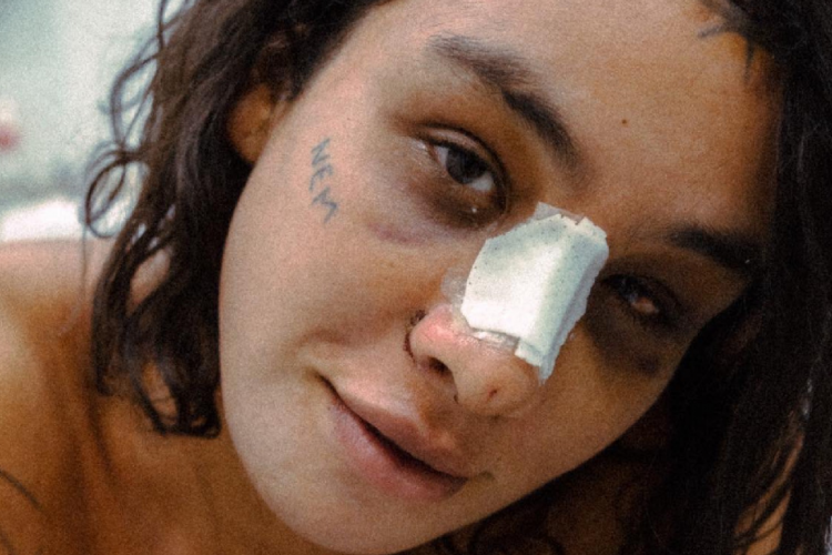 Ex-BBB Linn da Quebrada compartilha pós-operatório de cirurgias de feminização facial