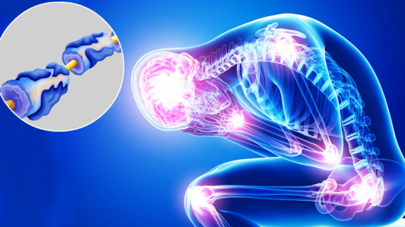 A s&iacute;ndrome Guillain-Barr&eacute; se manifesta a partir da sensa&ccedil;&atilde;o ascendente de dorm&ecirc;ncia ou queima&ccedil;&atilde;o nas extremidades dos membros inferiores e superiores; entenda