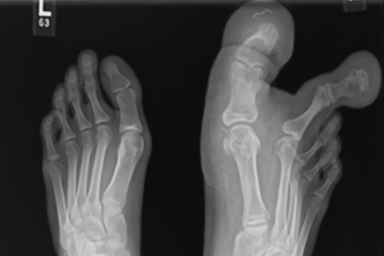 Apesar do quadro, a menina não reclamava de dor, mesmo que andasse por um longo tempo ou ao subir e descer escadas