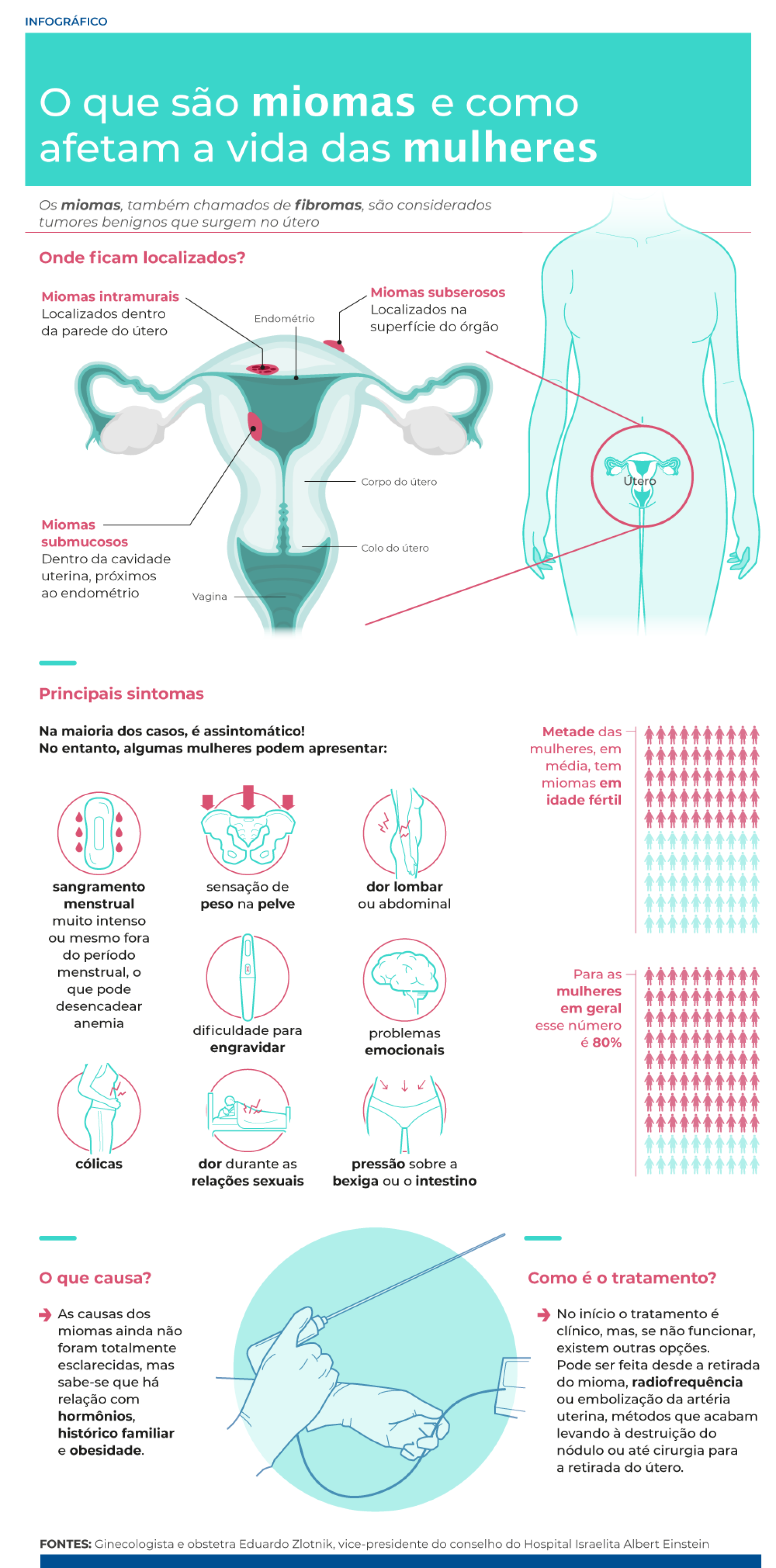 Miomas são tumores benignos que surgem no útero; entenda os tipos de mioma, os sintomas e os tratamentos 
