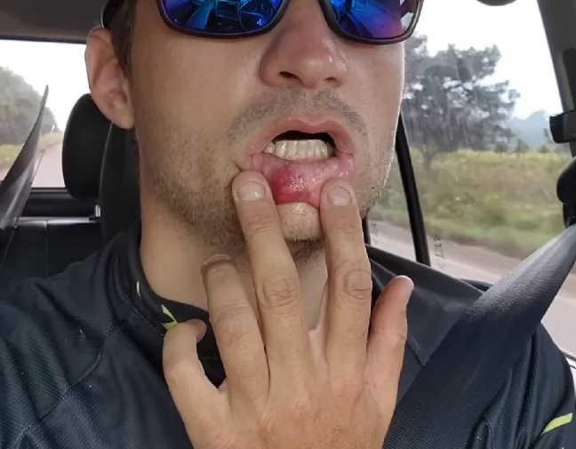 Na hora de devolver o peixe para o rio - pois o objetivo não era matar, mas registrar a captura do animal para a rede social -  o peixe dá um bote na tentativa de se soltar e acaba atingindo a boca do pescador.