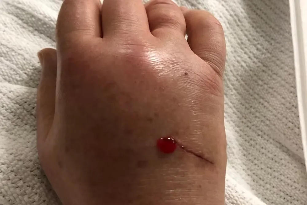 Segundo especialistas, quem encontra um ornitorrinco ferido, deve gravar vídeos, tirar fotos e enviar a equipes responsáveis por resgate de animais selvagens. Nunca deve pegar o animal.  Ao relatar a tentativa de resgate, Forward disse que sentiu uma  dor repentina e insuportável e, logo, percebeu que o esporão estava fixado em sua mão.