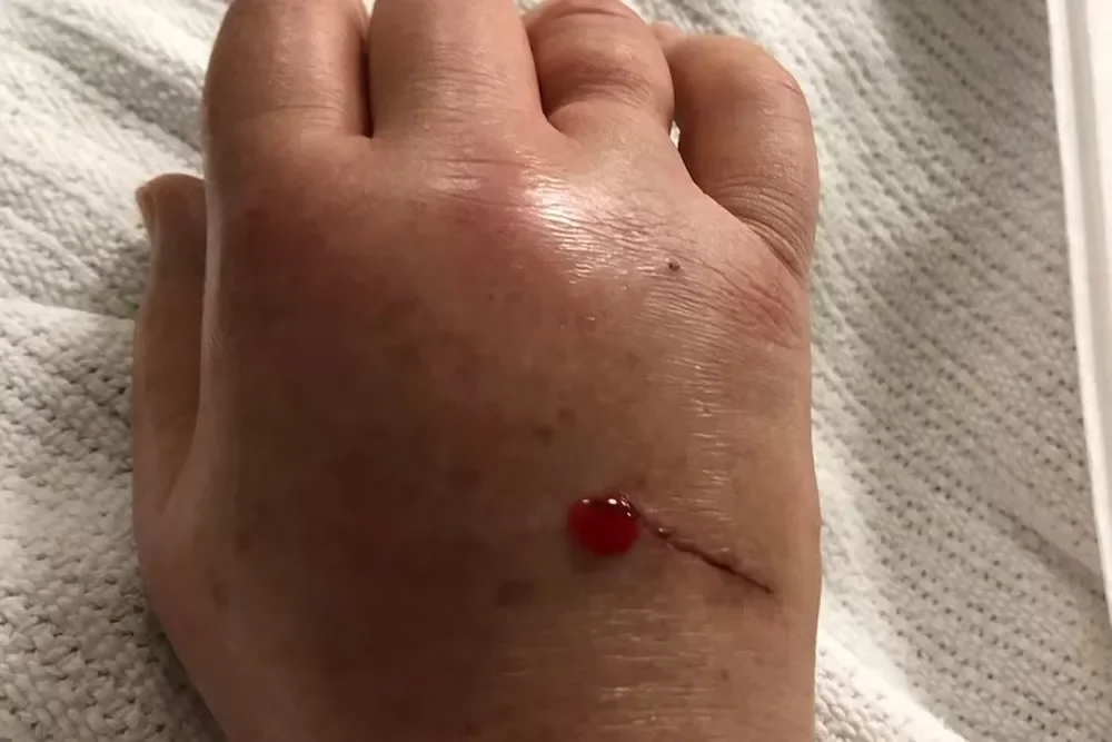 Segundo especialistas, quem encontra um ornitorrinco ferido, deve gravar vídeos, tirar fotos e enviar a equipes responsáveis por resgate de animais selvagens. Nunca deve pegar o animal.  Ao relatar a tentativa de resgate, Forward disse que sentiu uma  dor repentina e insuportável e, logo, percebeu que o esporão estava fixado em sua mão.