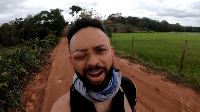 Após as ferroadas, ele descobriu que é alérgico: “Quase perco meu olho , publicou nas redes sociais. Essa reação alérgica que Felipe sofreu é conhecida como ‘angiodema’ e se caracteriza exatamente pelo inchaço de regiões como os olhos e os lábios 