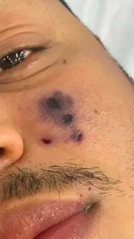 A família acha que a picada aconteceu na sua própria casa, em Miranorte. E  postou fotos mostrando como ficou o rosto do cantor, que começou a escurecer no local da picada. Darlyn desenvolveu alergias e foi levado para o hospital, mas acabou morrendo.