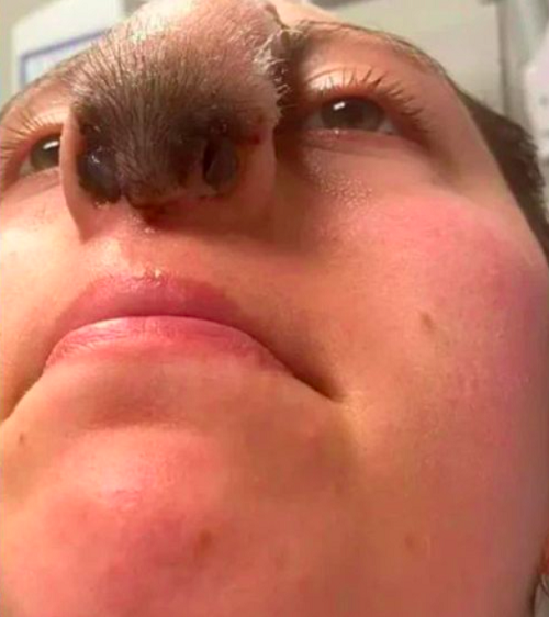 Segundo especialistas, um enxerto só é feito quando não se consegue fechar um ferimento com curativos simples e a perspectiva de recuperação não é boa. Outras razões para recorrer a um enxerto são quando a cicatrização é demorada, há muitas dores, aspecto estético deformado e risco de contaminação. 