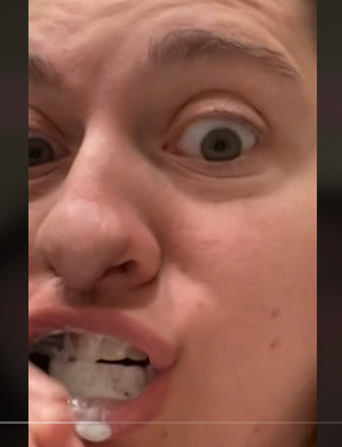 Há três tipos de enxerto: quando é retirado do próprio paciente (autoenxerto), quando é retirado de outra pessoa (aloenxerto ou homoenxerto) ou o xenoenxerto, quando a parte a ser enxertada é retirada de outra espécie (de suínos, por exemplo).